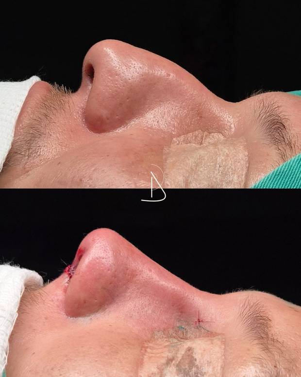 Rinoplastia, antes e depois · Dr. Ricardo Almeida