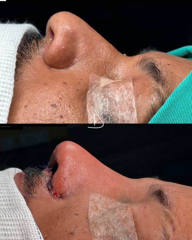 Rinoplastia, antes e depois · Dr. Ricardo Almeida