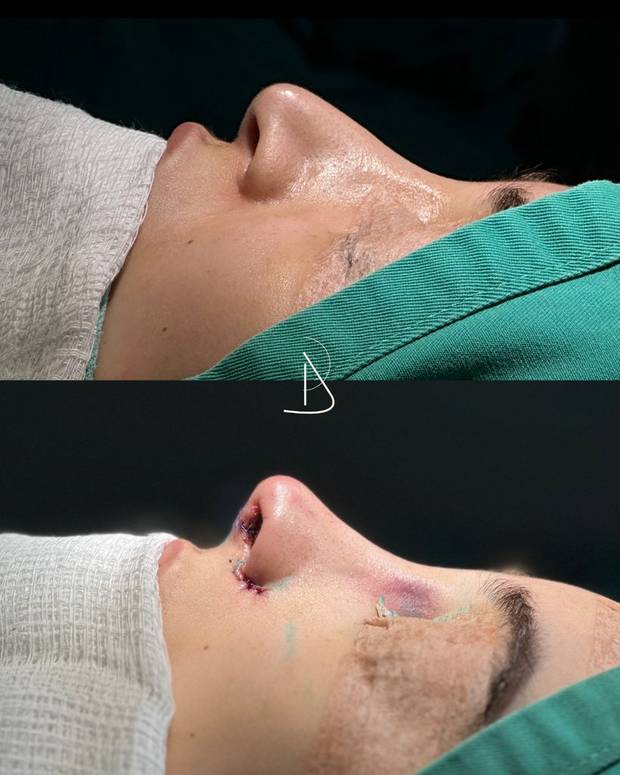 Rinoplastia, antes e depois · Dr. Ricardo Almeida