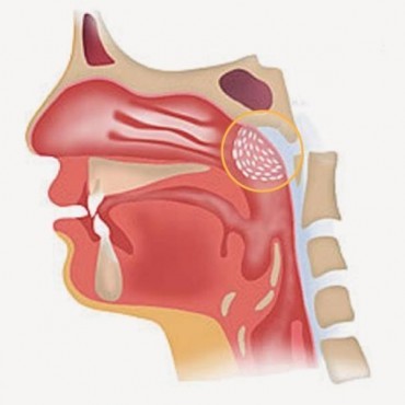 Tratamento dos Problemas de Adenóide em Ipameri