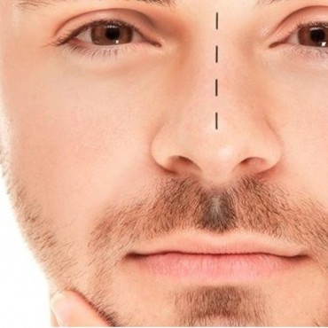 Tratamento do Desvio de Septo em Ipameri