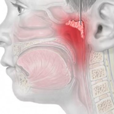Adenoidectomia em Ipameri