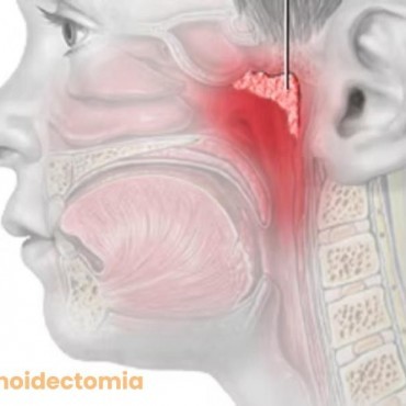 Adenoidectomia em Anápolis
