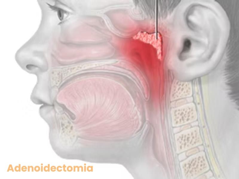 Adenoidectomia